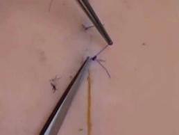 他院手術後の抜糸
